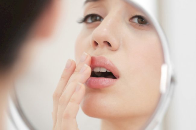 Uçuk Nasıl Geçer? Doğal Yollarla Uçuk Geçirme Yöntemleri